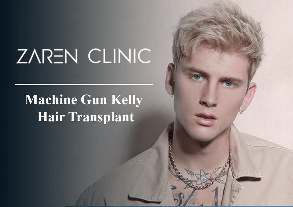 Machine Gun Kelly hair transplant