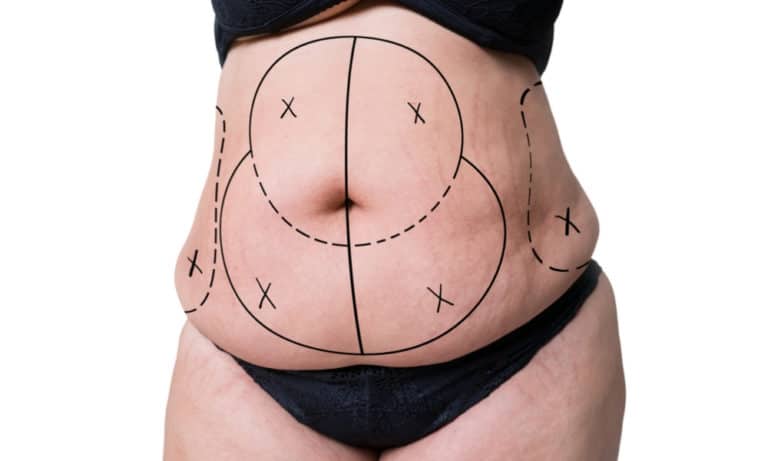 how much is a tummy tuck in turkey