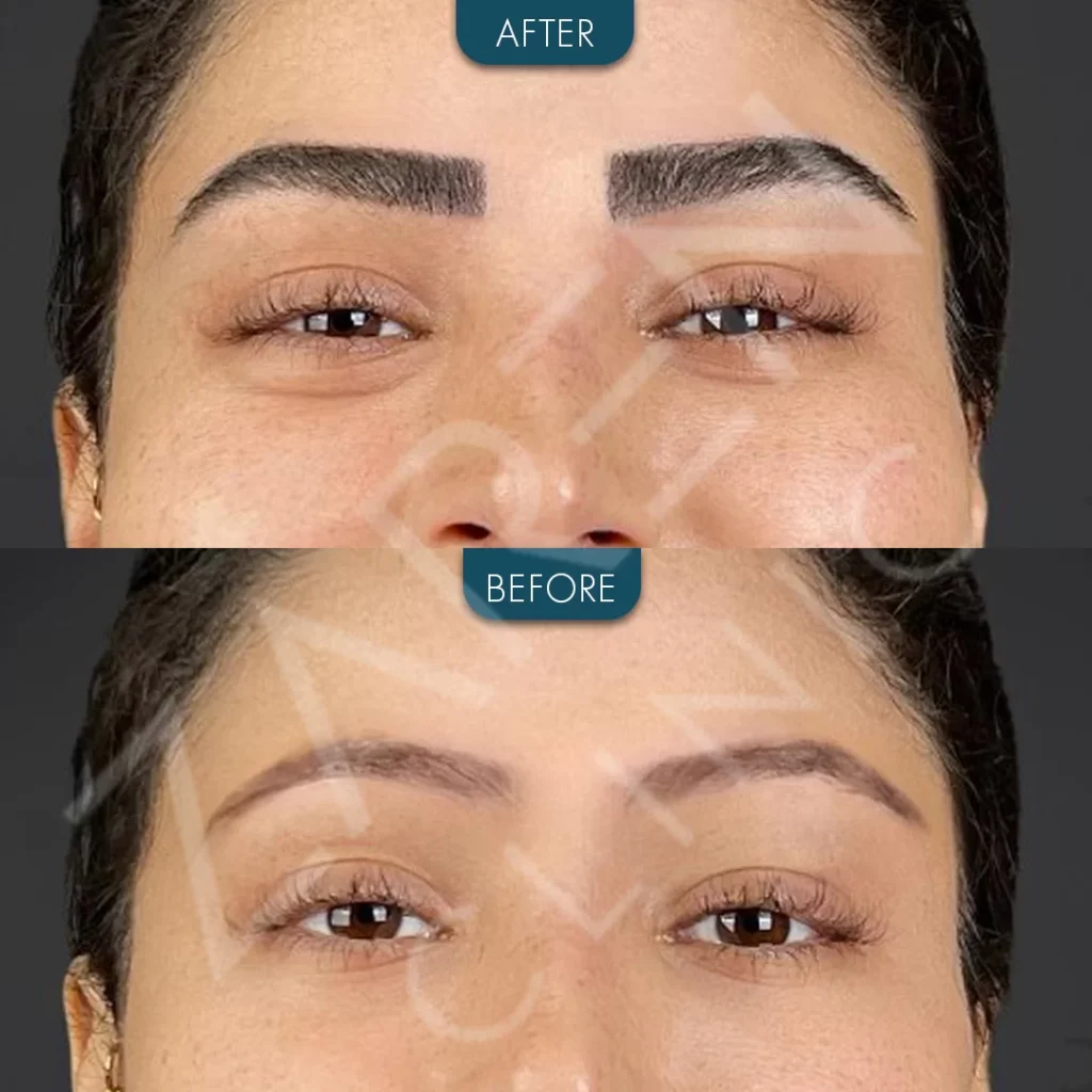trasplante de cejas antes y después