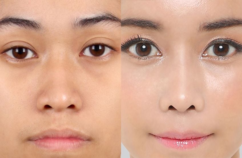 Asiatische Nasenkorrektur vorher und nachher