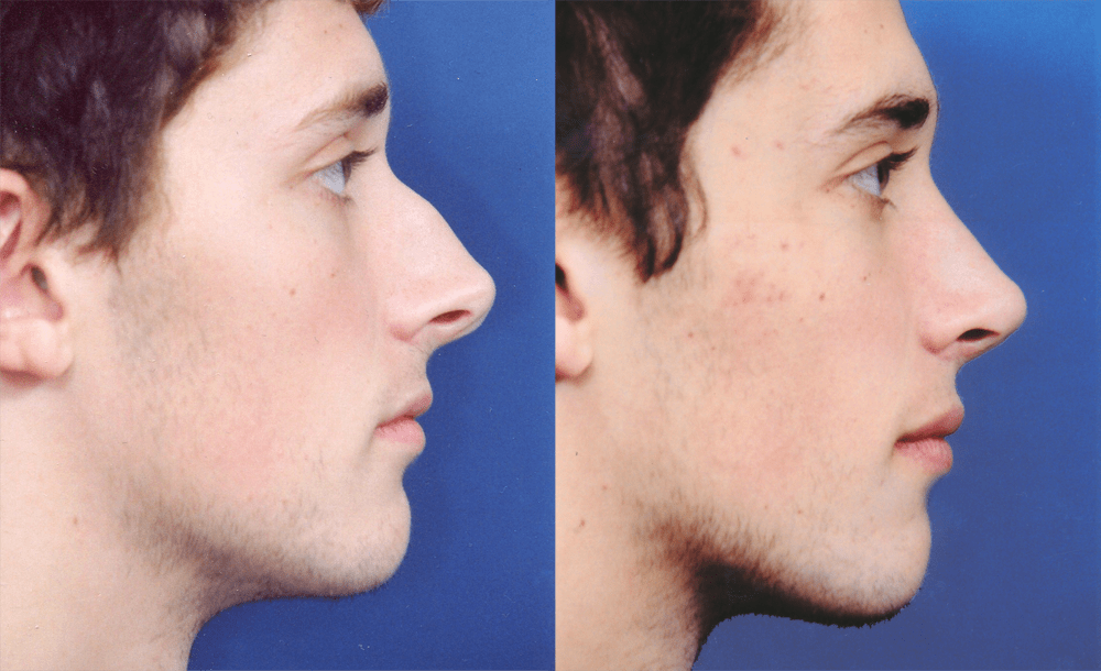 Ринопластика большого носа до и после