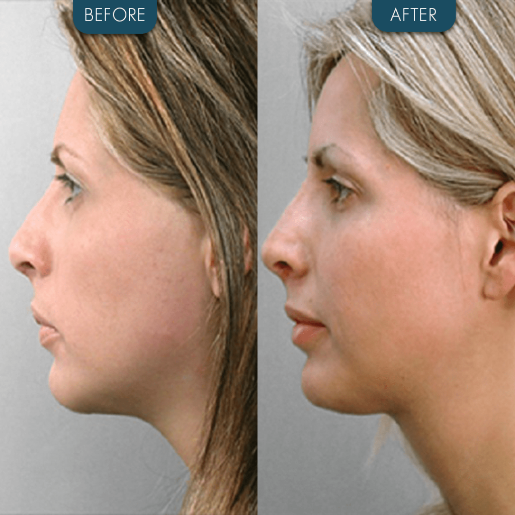 Chin Implant Before and After female 3