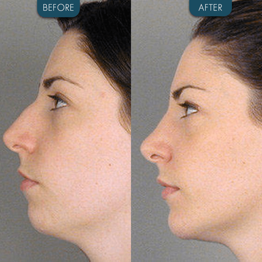 Chin Implant Before and After Female