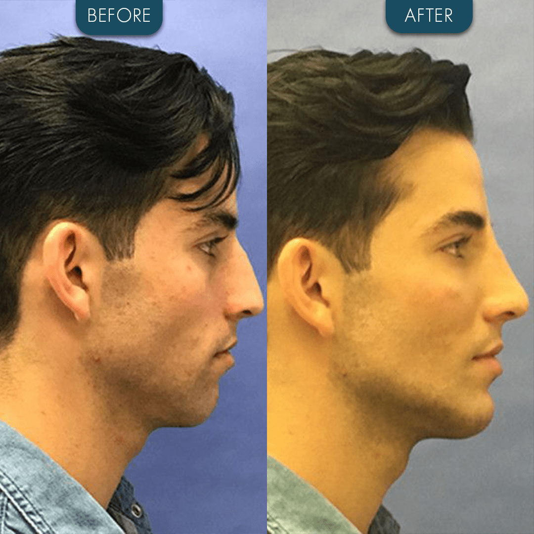 Chin implant Before and After - Zaren Health