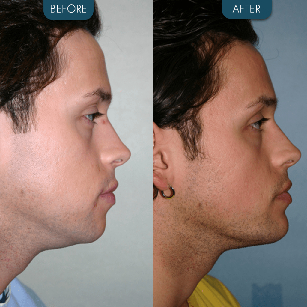 Chin Implant Before and After Male 2