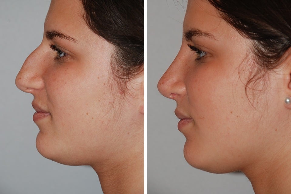 Closed Rhinoplasty Before and After