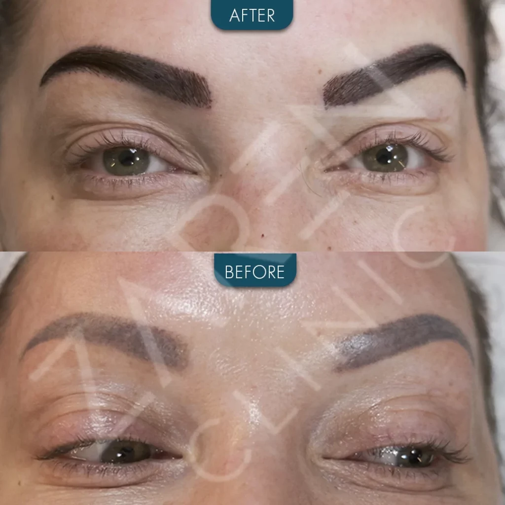 eyebrow transplant before and after