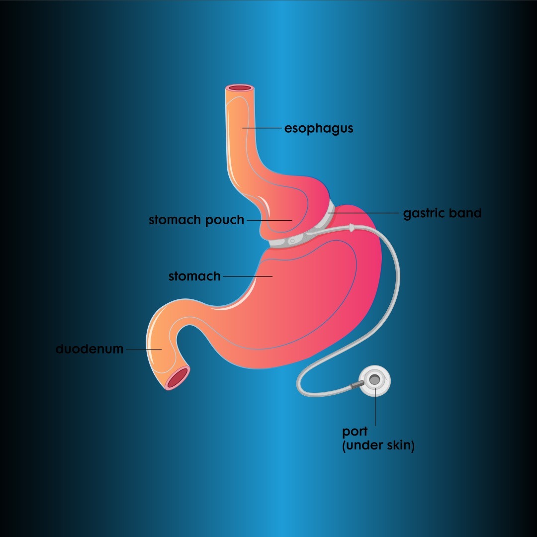 Bandă gastrică ajustabilă laparoscopică (LAGB)