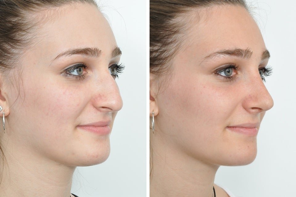 Lucru la nas înainte și după