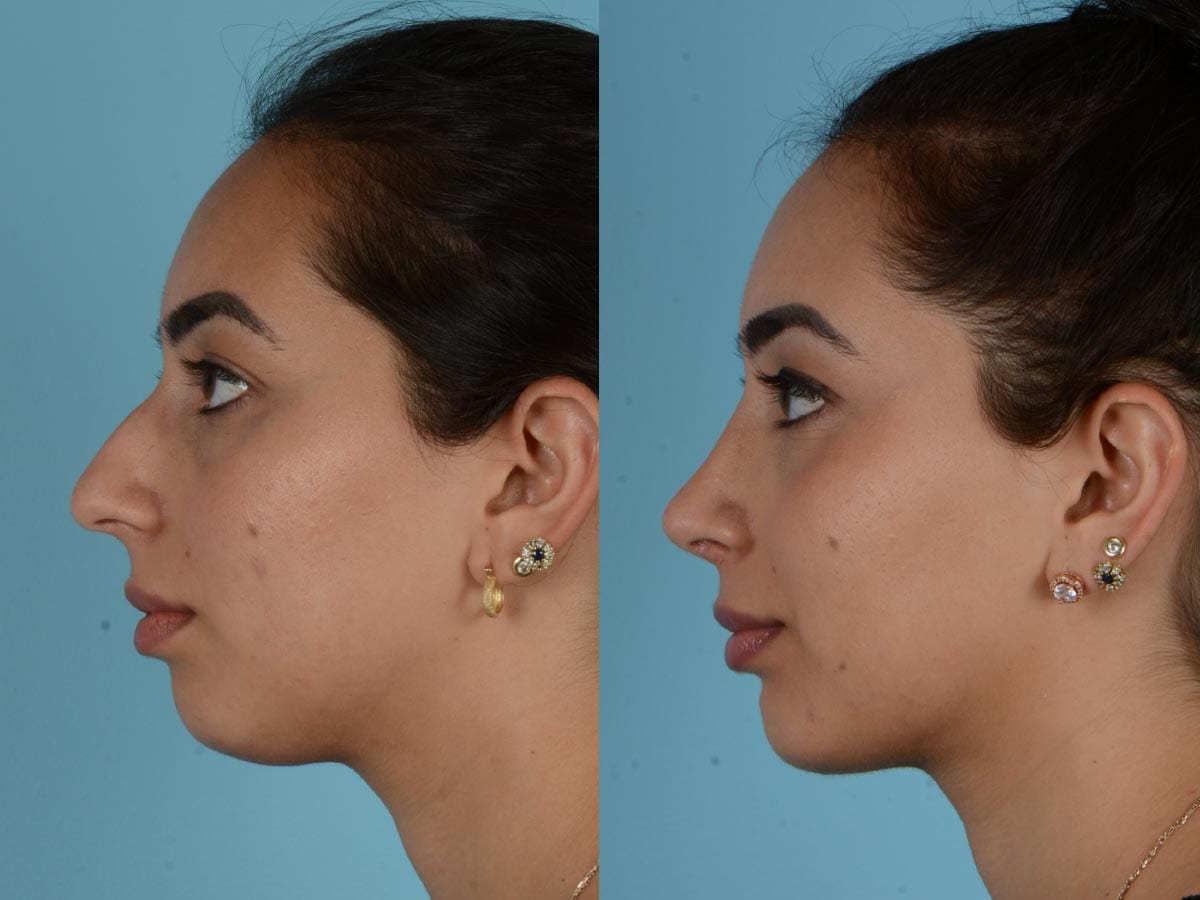 Nasenkorrektur bei Frauen vor und nach der Operation