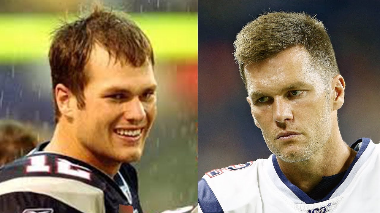 Foto de antes y después del trasplante de cabello de Tom Brady