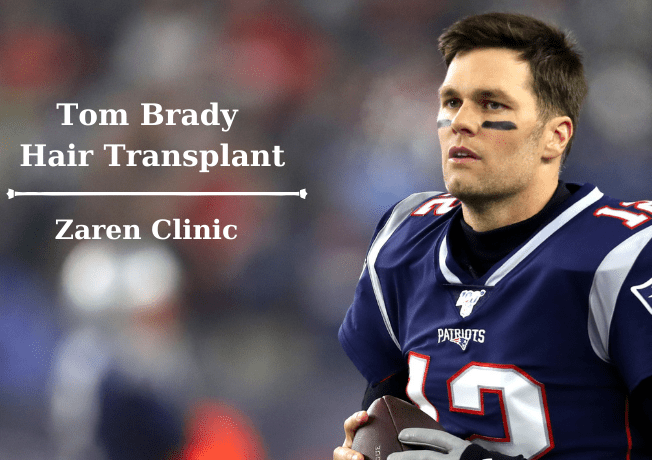 Transplante capilar de Tom Brady