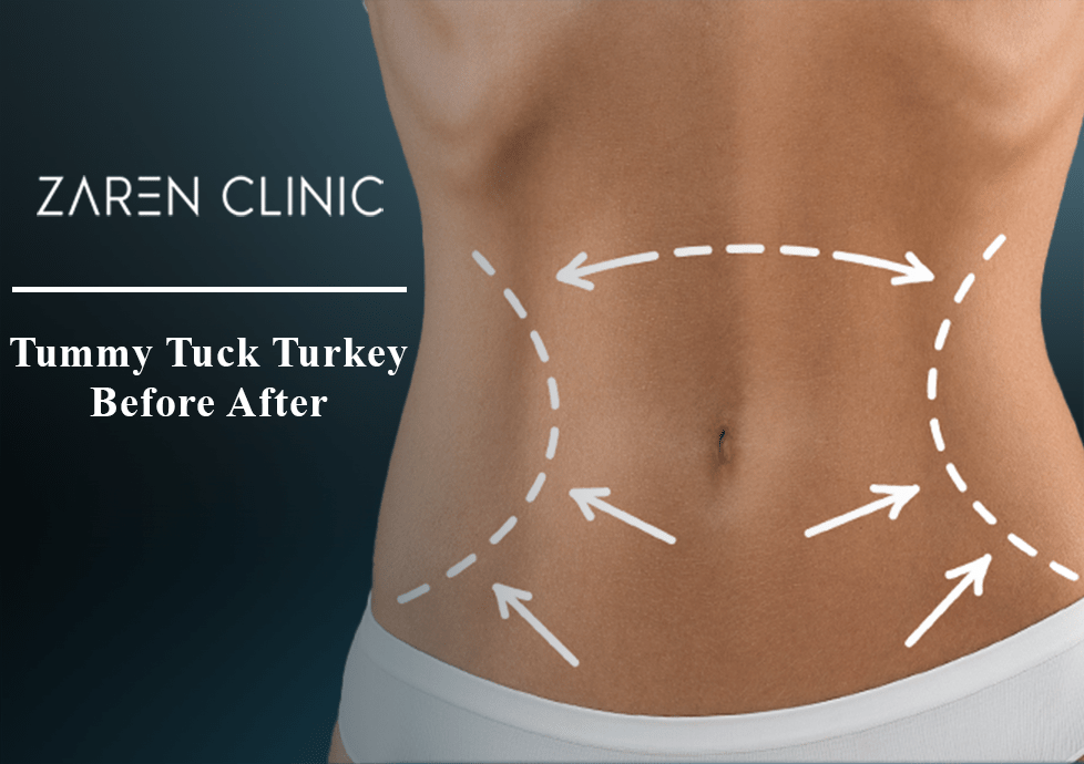 A abdominoplastia Turquia antes e depois é importante para muitas pessoas. Você se pergunta como serão os resultados. Vamos explorar fotos de abdominoplastia antes e depois na Turquia.