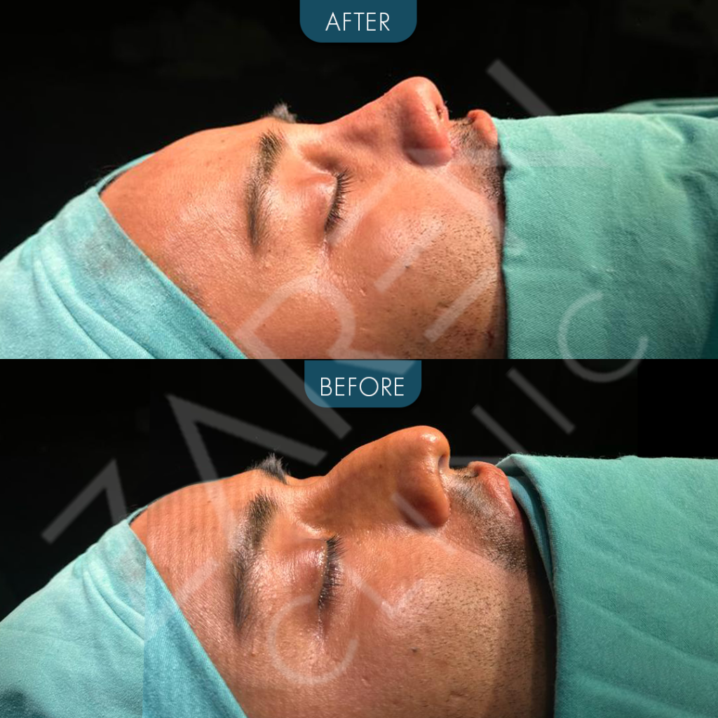 rhinoplasty istanbul before and after
