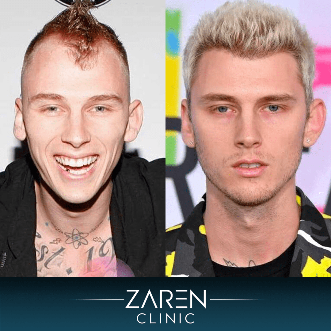 Mgk Before and After Hair Transplant