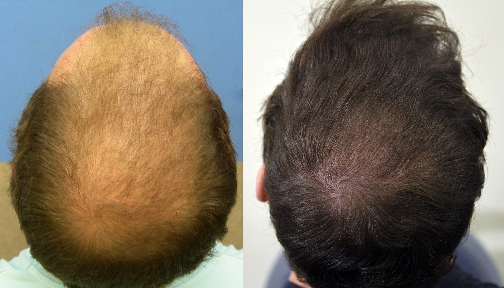 Hair Transplant after 10 Years - Zaren Clinic