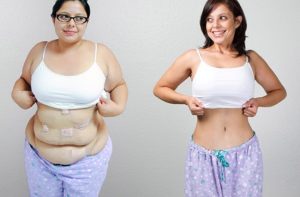 gastric bypass skin