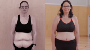 Bariatric Surgery Before and After Skin