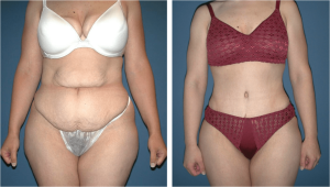 Gastric Sleeve Before and After Picture