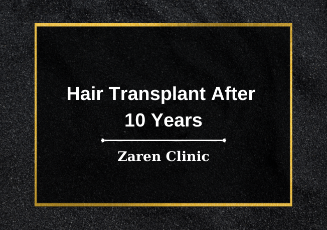 Трансплантација косе после 10 година