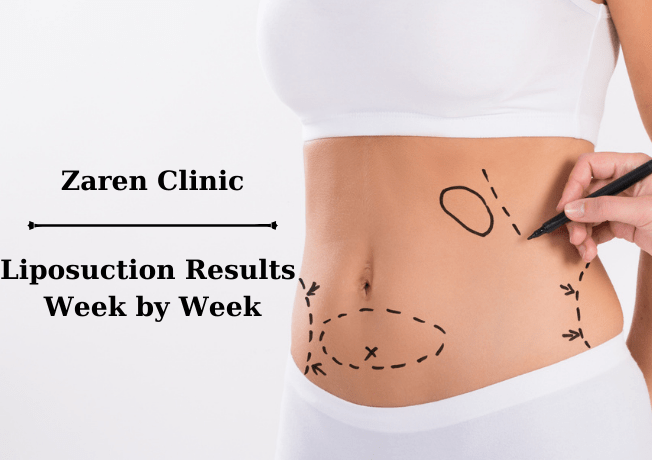 Liposuktionsergebnisse Woche für Woche