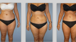 Stomach Liposuction Results Week by Week