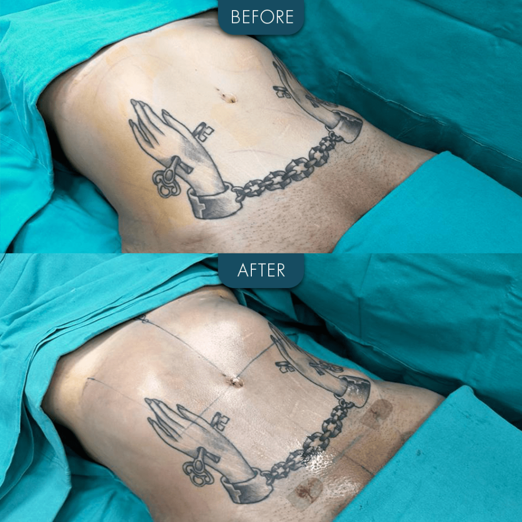 Liposuction before and after