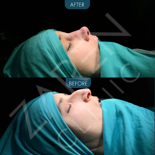 rhinoplasty Istanbul before_and_after