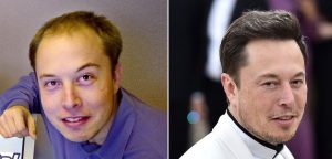 Transplante de cabelo de Elon Musk antes e depois