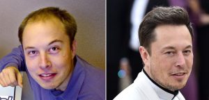 Trasplante capilar de Elon Musk antes y después