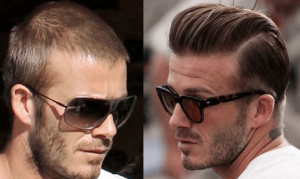 Transplantacija kose Davida Beckhama. Uostalom, izgled i samopouzdanje osobe usko su povezani s kvalitetom kose.