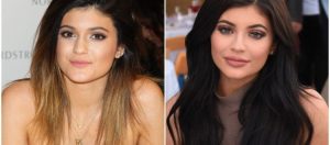 Kylie Jenner prima e dopo le foto della mascella
