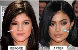 Kylie Jenner before and after nose picture