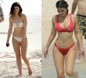 antes e depois dos seios da Kylie