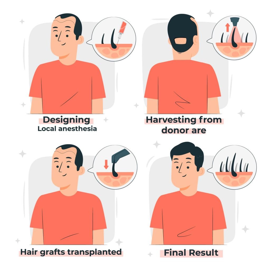 Die Anzahl der Haartransplantationsgrafts verstehen: Was Sie wissen müssen