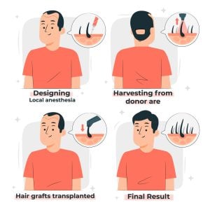 Înțelegerea numerelor de grefă de transplant de păr: Ce trebuie să știți