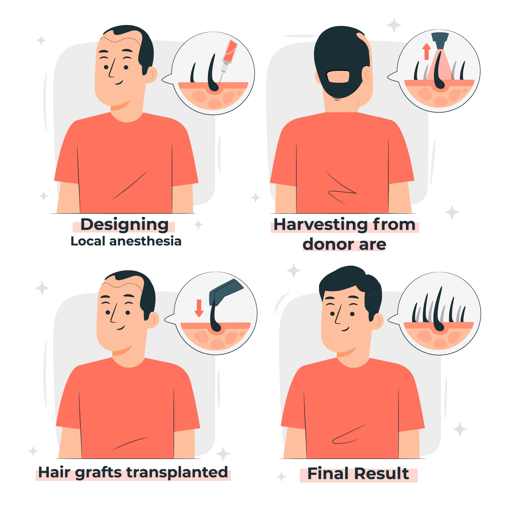 Înțelegerea numerelor de grefă de transplant de păr: Ce trebuie să știți