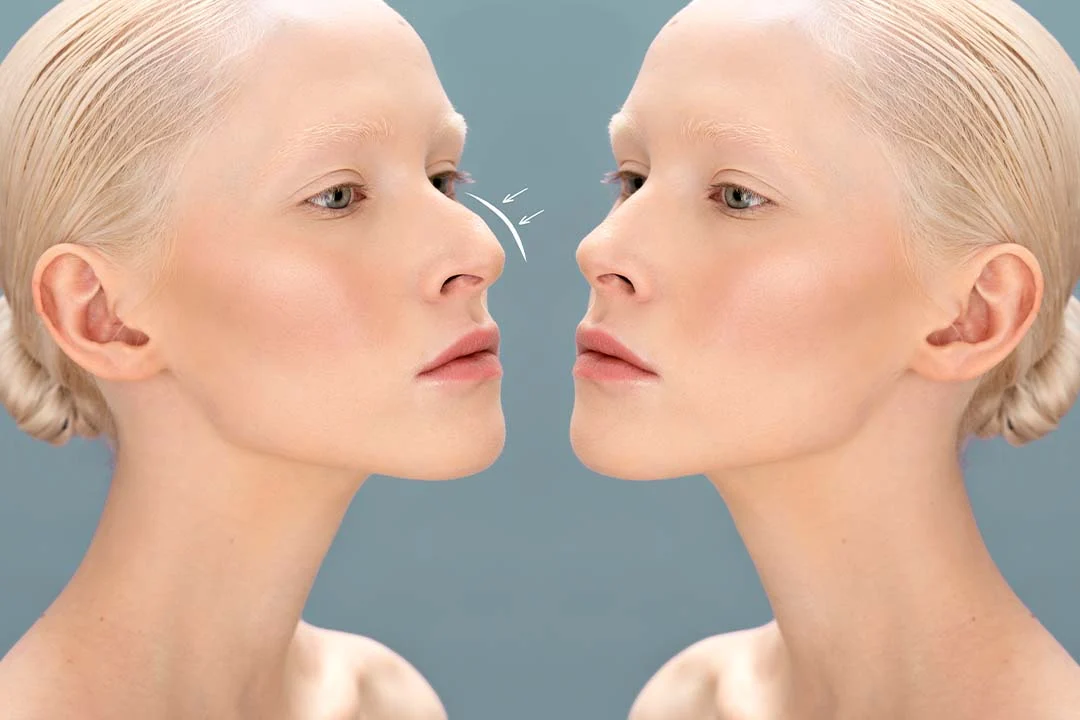 Rhinoplasty Austin