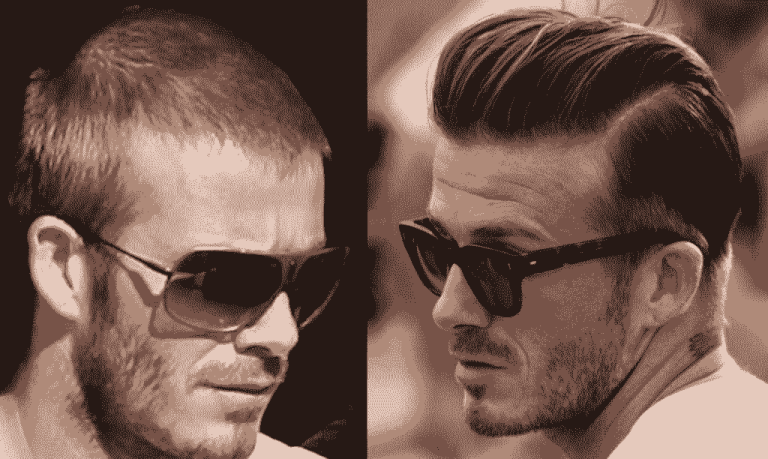 Trasplante Capilar De David Beckham - Zaren Health