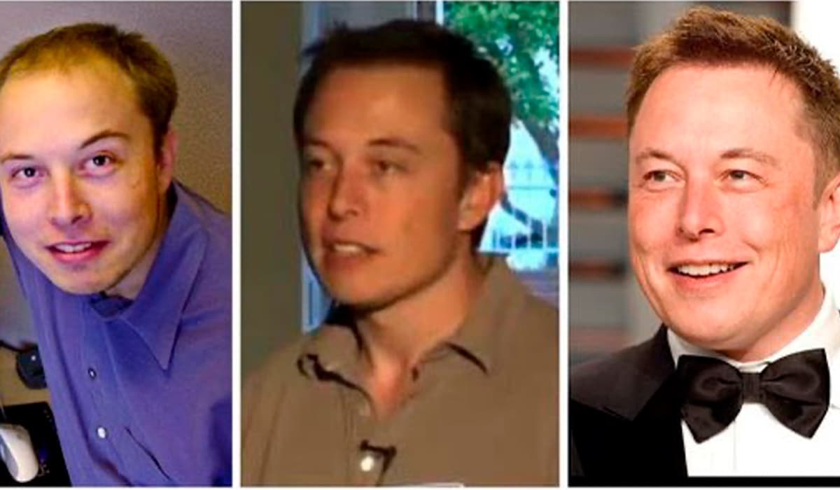 Elon Musk Hair Transplant Everything to Know Zaren Health