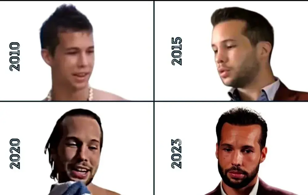 Tristan Tate Hair Transplant Amazing Change