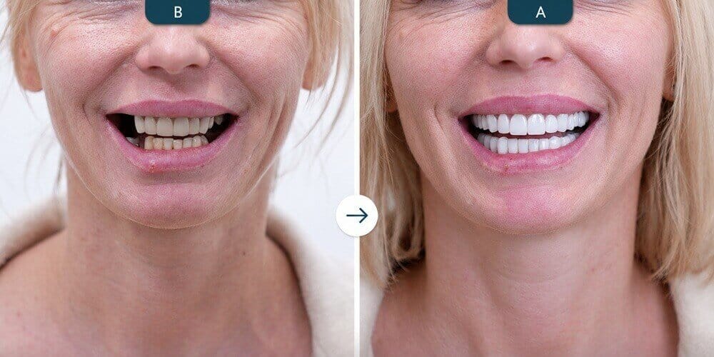 How Did Hollywood Smile Dental Aesthetics Originate? History and Evolution