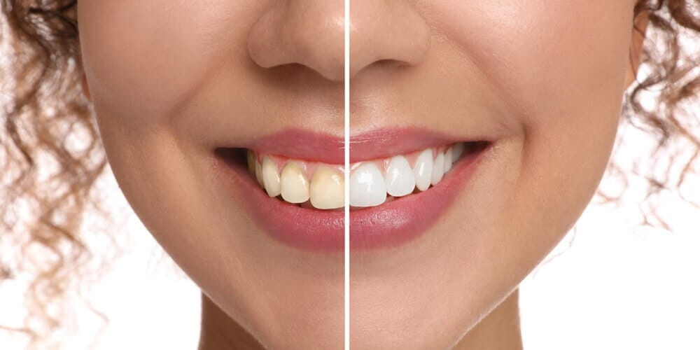 How Did Hollywood Smile Dental Aesthetics Originate? History and Evolution
