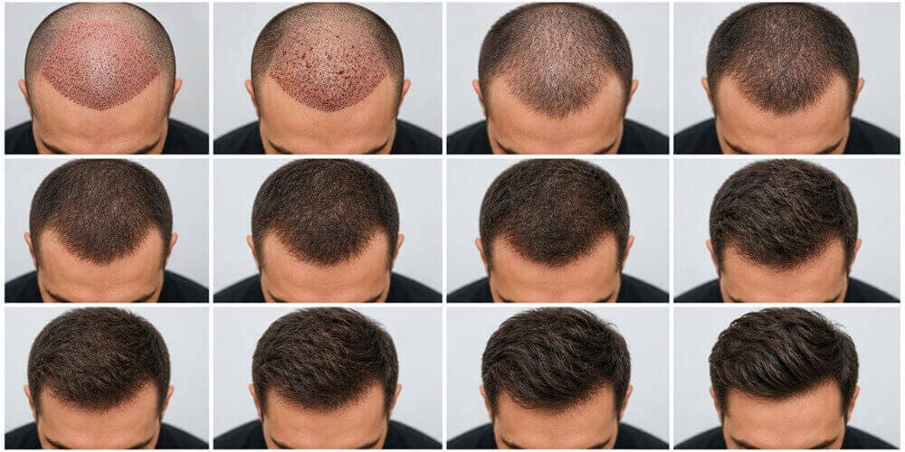 Wie sieht das Haar ein Jahr nach einer Haartransplantation aus?