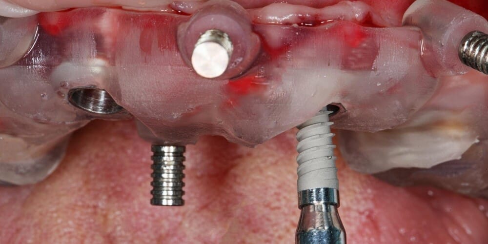 Implants All-on-4 en Turquie : traitement par prothèse dentaire fixe