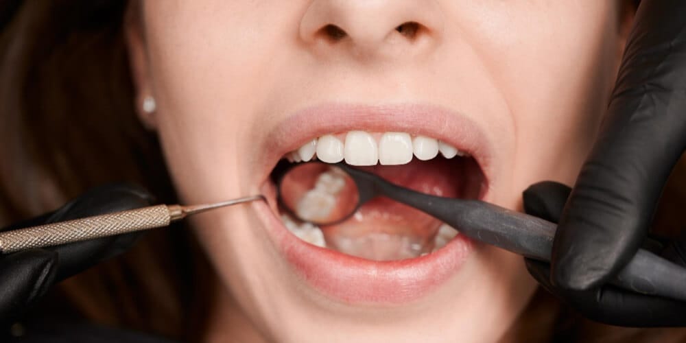Odontoiatria restaurativa in Turchia: otturazioni, corone e faccette