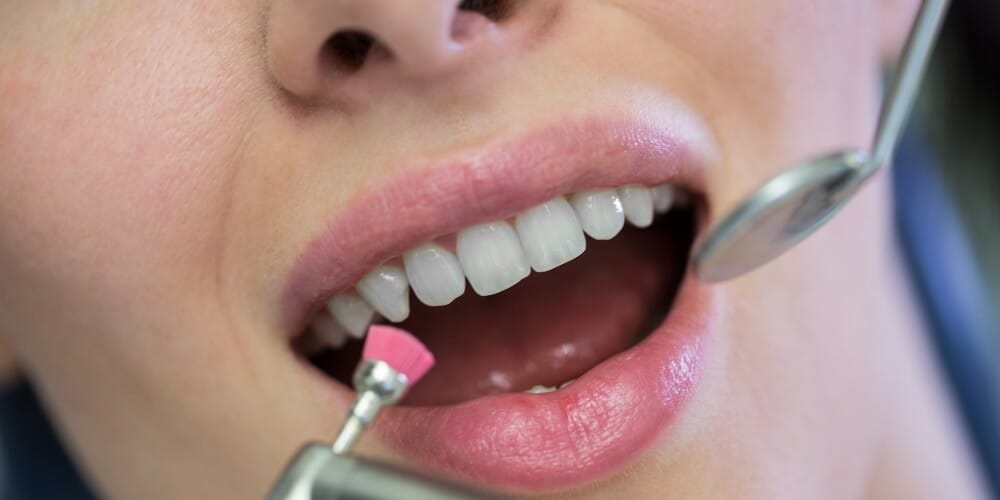 Ricostruzione dentale con composito in Turchia per un sorriso dall’aspetto naturale