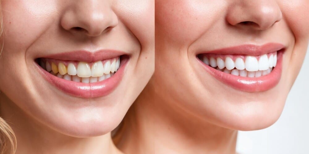 Ricostruzione dentale con composito in Turchia per un sorriso dall’aspetto naturale