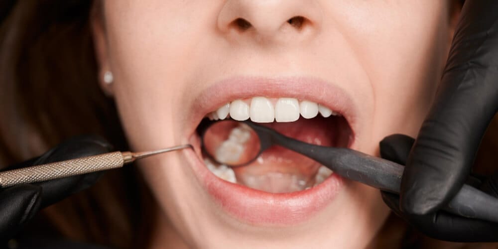 Composite Filling Turkey for Cavities, Cracks and Worn Teeth