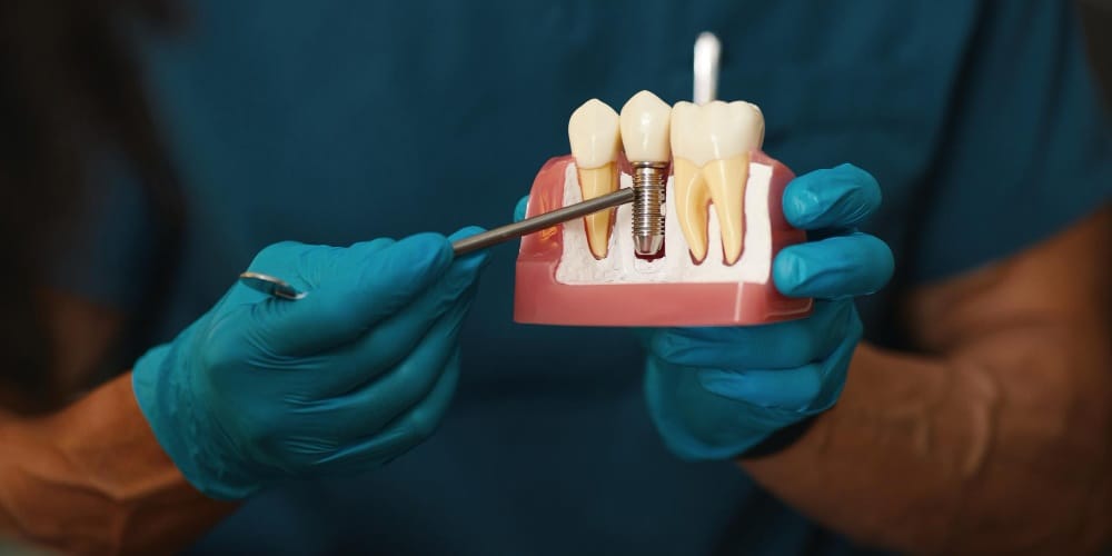Dental Implant Turkey: Natural-Looking Tooth Replacement